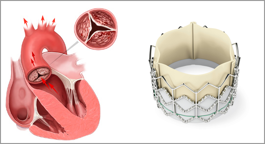 TAVR