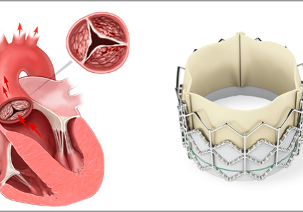 TAVR